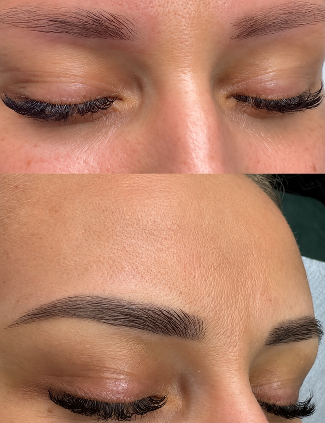 Exemple de détatouage laser des sourcils